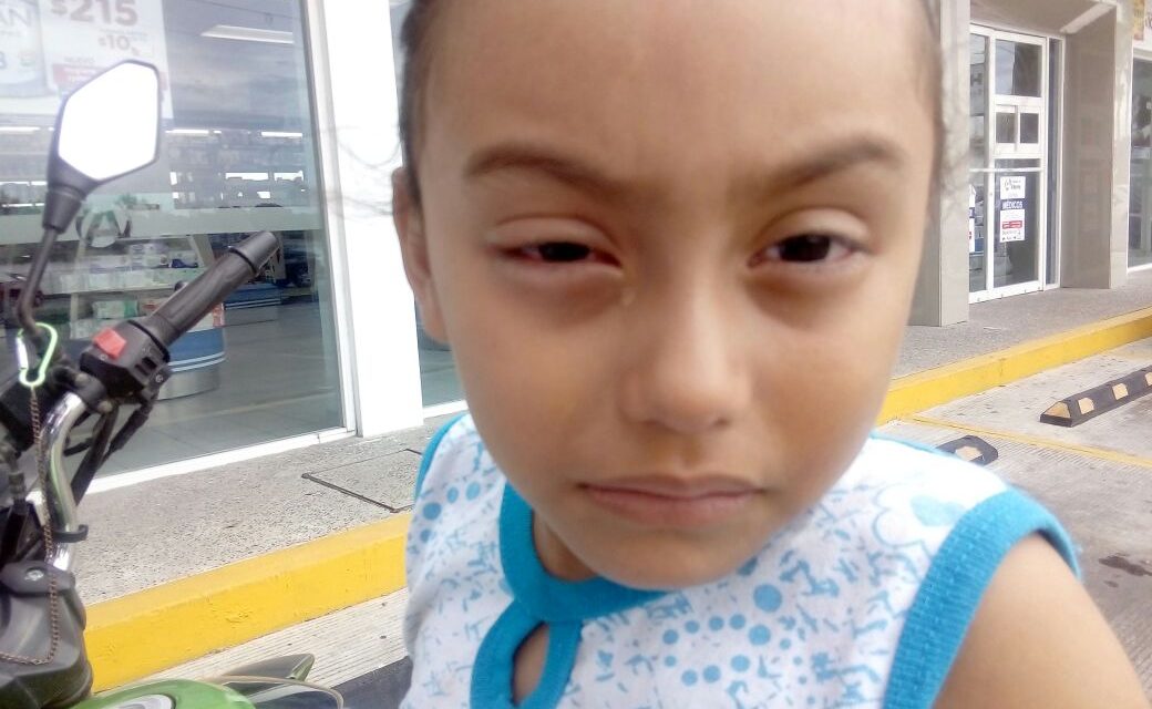 Buscan prevenir epidemia de Conjuntivitis